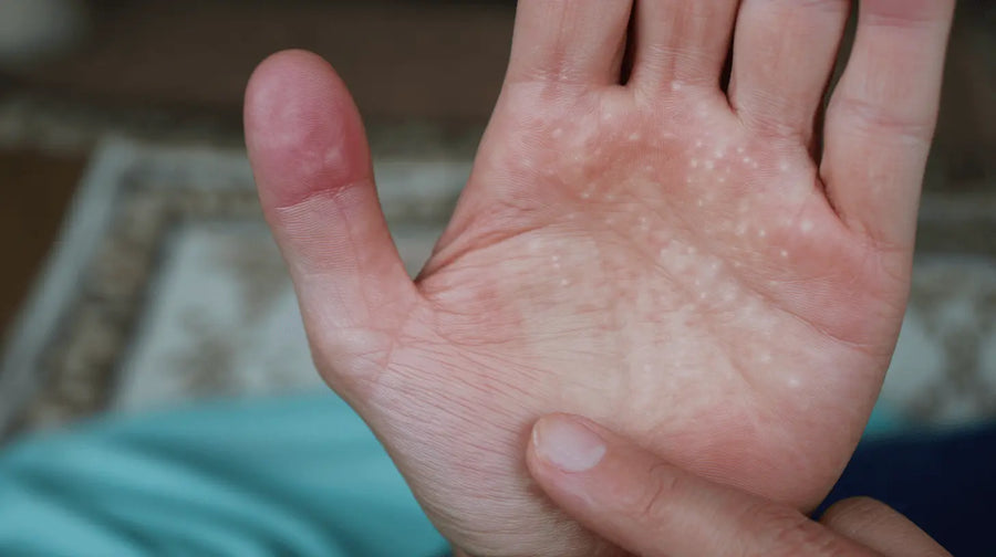 Why Dyshidrotic Eczema on Hands Struggles to Heal Inside Gloves